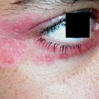 
	Facial psoriasis
	
	A well-defined plaque