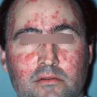 Facial psoriasis