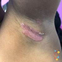 Flexural psoriasis&nbsp;
Copied with kind…