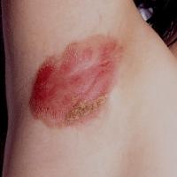 
	Flexural psoriasis in the axilla