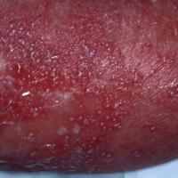 
	Generalised pustular psoriasis: close-up