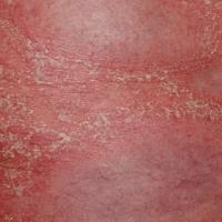 
	Generalised pustular psoriasis: close-up