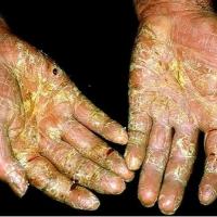 
	Hyperkeratotic psoriasis

	Copied with kind…