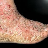 
	Hyperkeratotic psoriasis - severe&nbsp;