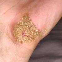 
	Hyperkeratotic psoriasis affecting the…