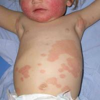 Psoriasis in an infant