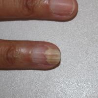 
	Nail psoriasis
	
	Onycholysis. Not all nails…