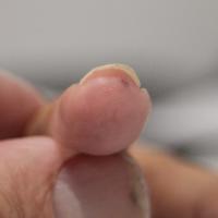 As previous image
Distal nail plate has…