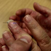 
	Nail psoriasis 
	
	Onycholysis (black arrow),…