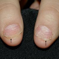 
	Nail psoriasis
	
	Subungual hyperkeratosis…