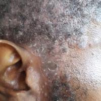 Scalp&nbsp;psoriasis
Copied with kind permission…