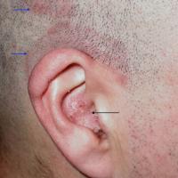 
	Scalp psoriasis in short hair
	
	This shows up…