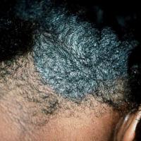 
	Scalp psoriasis 