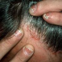 
	Scalp psoriasis affecting the hairline&nbsp;