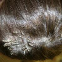 
	Pityriasis amiantacea secondary to…