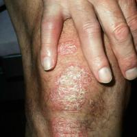 
	Psoriatic arthritis

	Skin and joints affected
