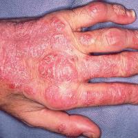
	Psoriatic arthritis

	Skin, nails and joints…