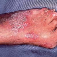 
	Psoriatic arthritis

	Skin, nails and joints…