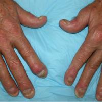 
	Psoriatic arthritis

	Nails and joints…