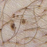 
	Pubic lice