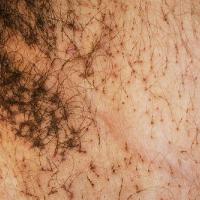 
	Pubic lice

	Louse faeces visible

	Copied with…