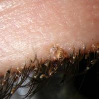 
	Involvement of the eyelashes