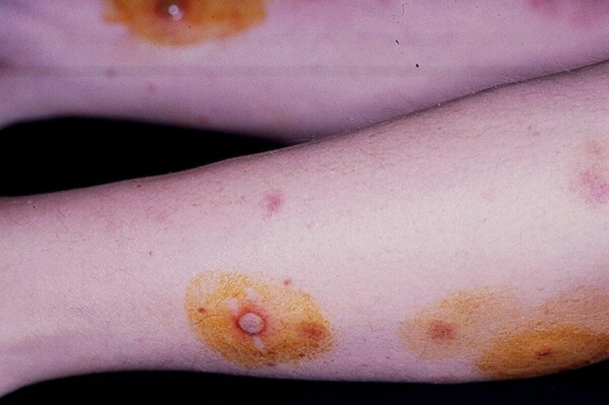 Proderma Rash What Is Pyoderma Gangrenosum Pictures – PIMF