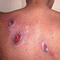 
	PG secondary to a haematological…