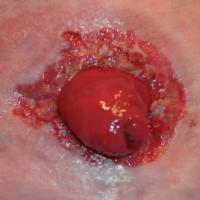 
	Peristomal PG