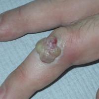 
	Pyogenic granuloma

	A history of trauma was…