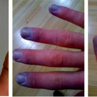 
	Raynaud's phenomenon