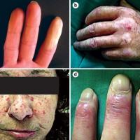 
	Systemic sclerosis

	a) Raynaud's…