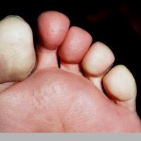 
	Raynaud's phenomenon