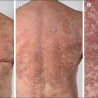 Rheumatoid arthritis (RA) and Still's disease