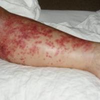
	RA - small vessel vasculitis 