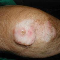 
	Rheumatoid nodule
