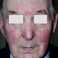 
	Rosacea
	
	Papules, pustules and…