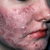 
	Severe rosacea

	Papules, pustules and nodules