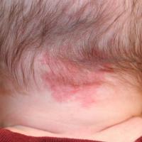 
	A salmon patch on the nape of the neck (a stork…
