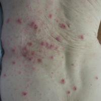 
	Scabies on the trunk with urticated papules
