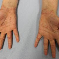 Same patient as previous figureInvolvement of the…
