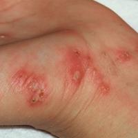 
	Scabies - wrists 