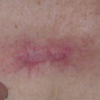 
	Hypertrophic scar 

	Post surgery on the…