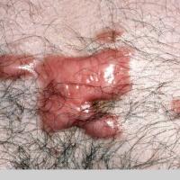 
	Keloid scar

	Extends beyond the original defect