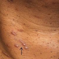 
	Scars following snip excision

	An important…