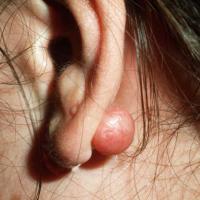
	Keloid scar - ear piercing 