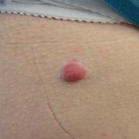 
	Spontaneous scar