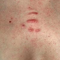 
	Keloid scars - mild acne

	This patient…