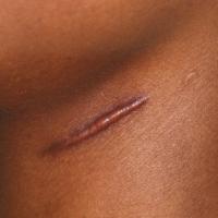 
	Hypertrophic scars

	Scar sits within initial…
