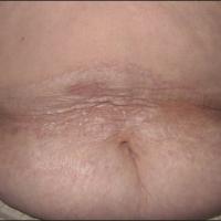
	Non-genital lichen sclerosus

	Lesions start as…
